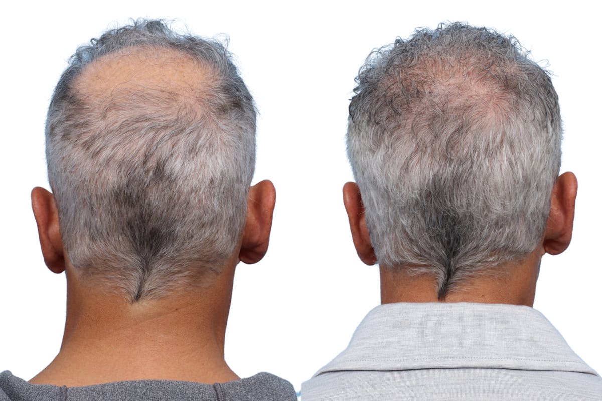 FUE Hair Transplant Before & After Gallery - Patient 289627 - Image 3
