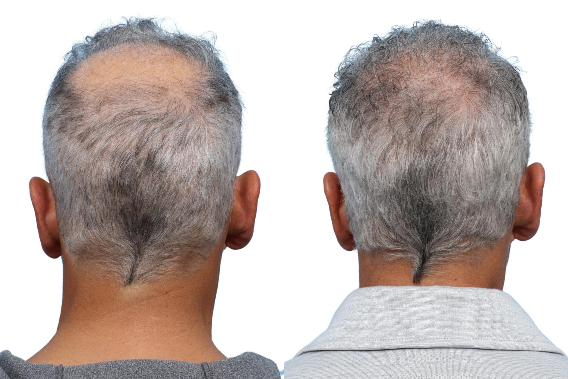 FUE Hair Transplant Before & After Gallery - Patient 289627 - Image 3
