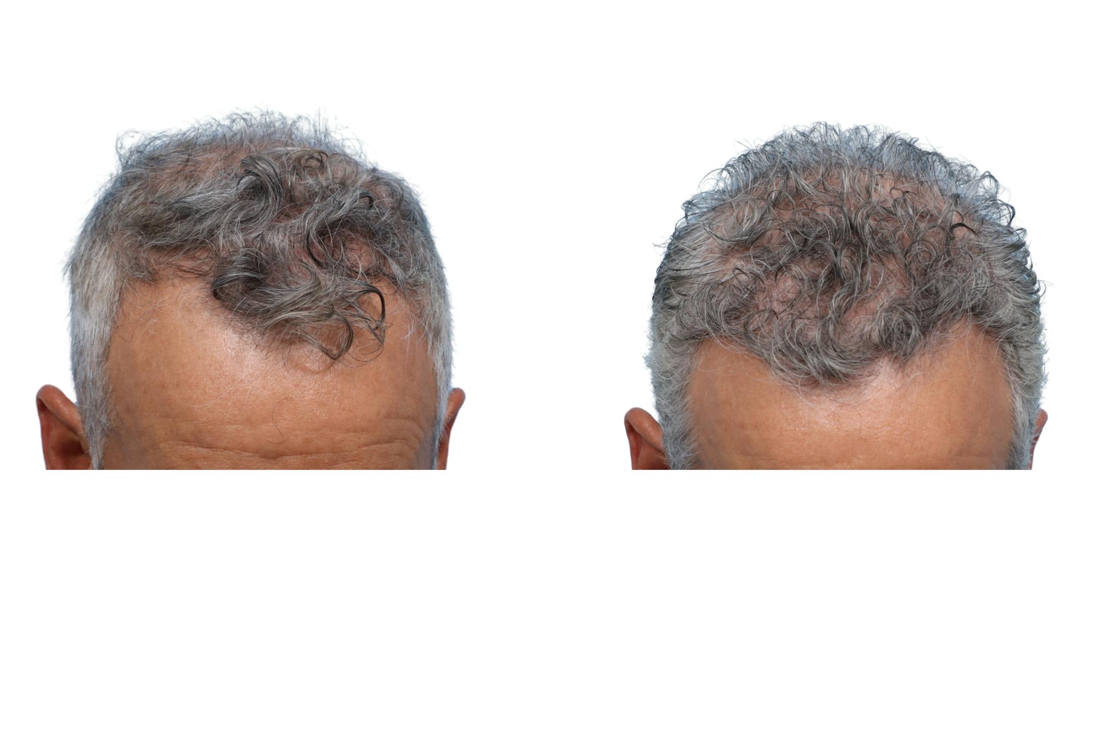 FUE Hair Transplant Before & After Gallery - Patient 289627 - Image 2