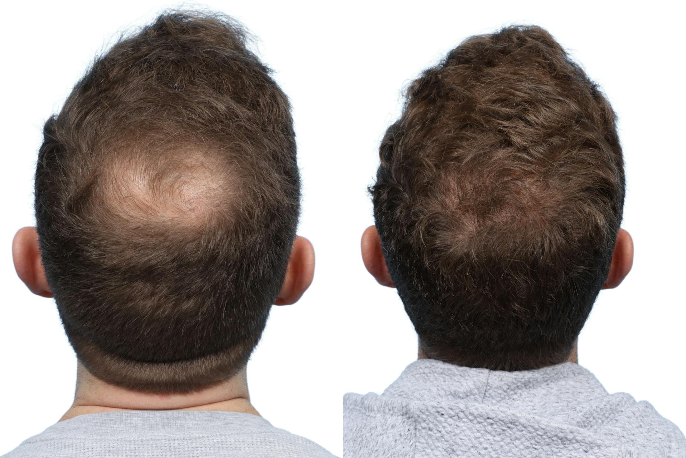 FUE Hair Transplant Before & After Gallery - Patient 262093 - Image 1