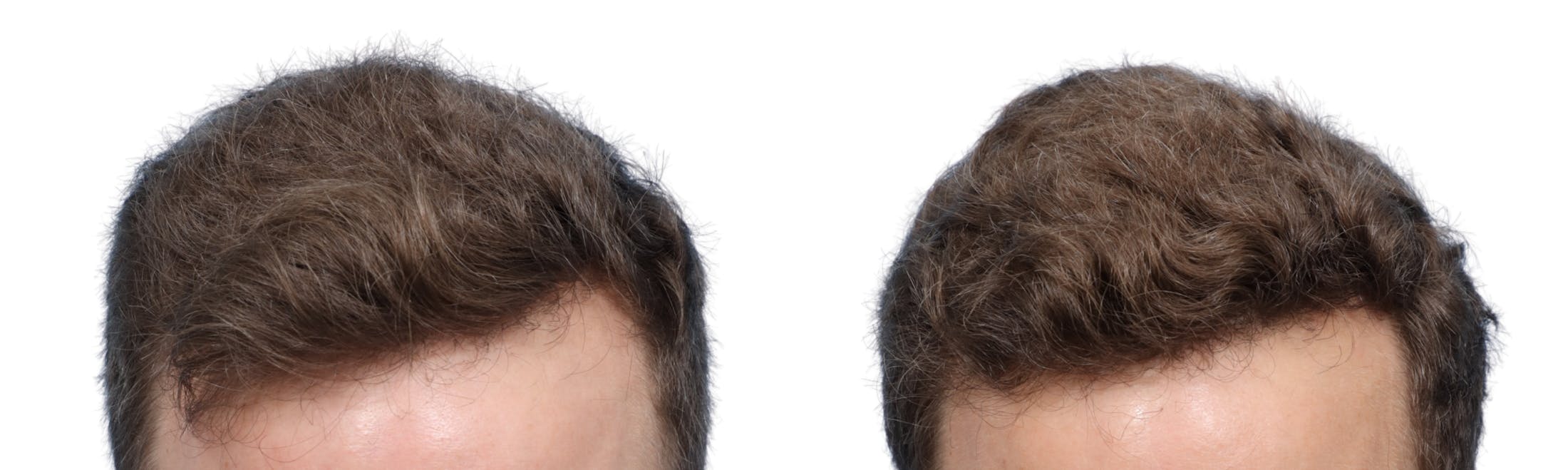 FUE Hair Transplant Before & After Gallery - Patient 262093 - Image 2