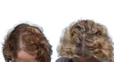 Platelet-Rich-Plasma Before & After Gallery - Patient 376247 - Image 1