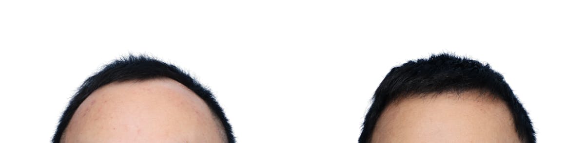 FUE Hair Transplant Before & After Gallery - Patient 262093 - Image 1