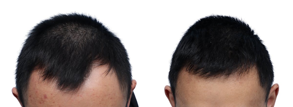 FUE Hair Transplant Before & After Gallery - Patient 262093 - Image 2