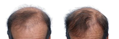 FUE Hair Transplant Before & After Gallery - Patient 229352 - Image 1