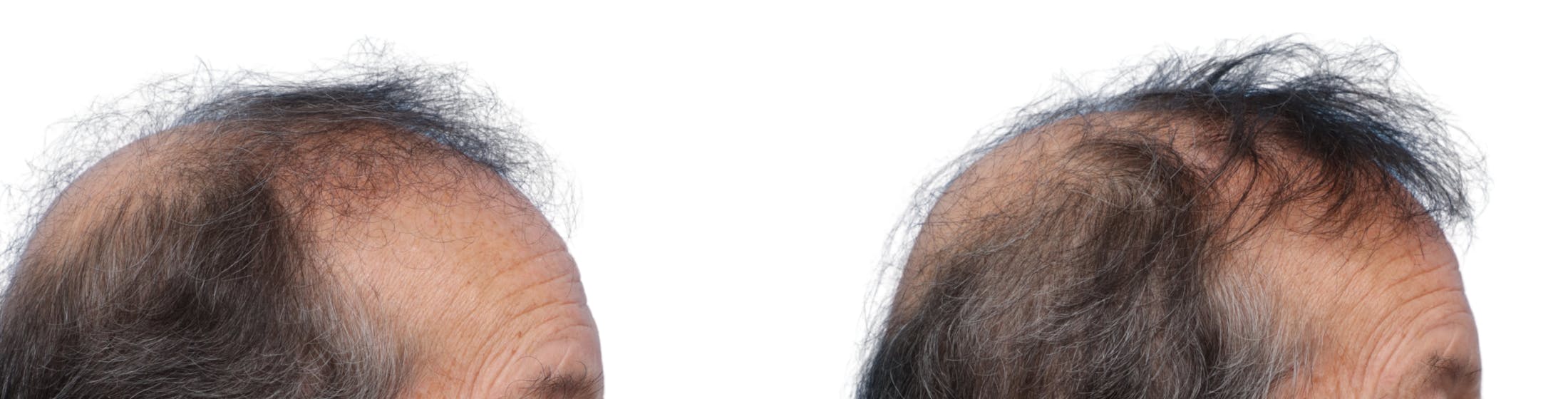 FUE Hair Transplant Before & After Gallery - Patient 229352 - Image 2