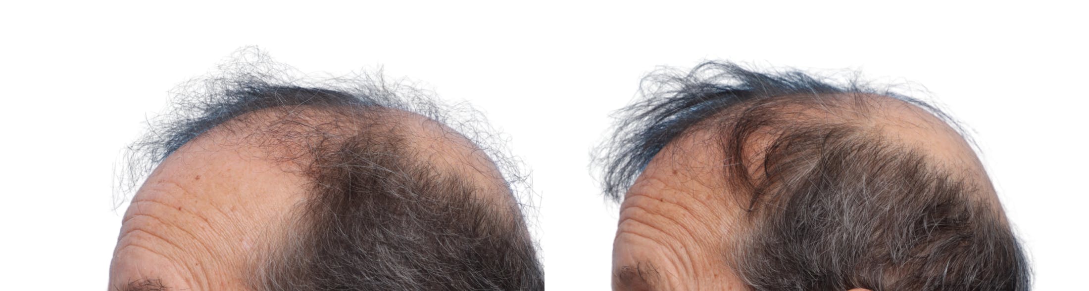 FUE Hair Transplant Before & After Gallery - Patient 229352 - Image 3
