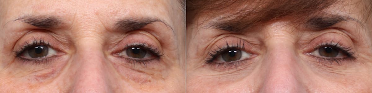 Blepharoplasty (Eyelid Surgery) Before & After Gallery - Patient 160349 - Image 1