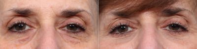 Blepharoplasty (Eyelid Surgery) Before & After Gallery - Patient 160349 - Image 1