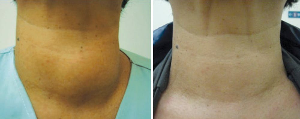 Person with enlarged thyroid