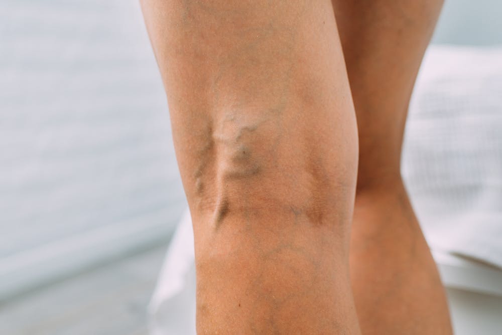 Woman with veins showing on legs