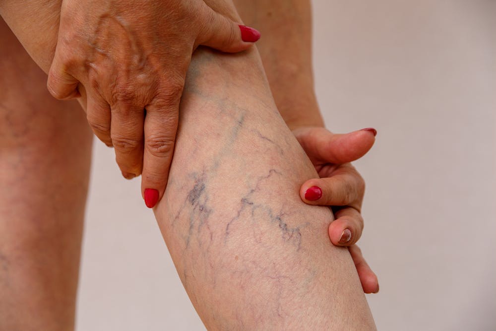 Woman with veins showing on her leg