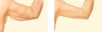 Before and after Arm Lift