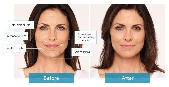 Before and After Radiesse