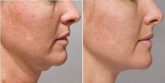 Before and after Kybella