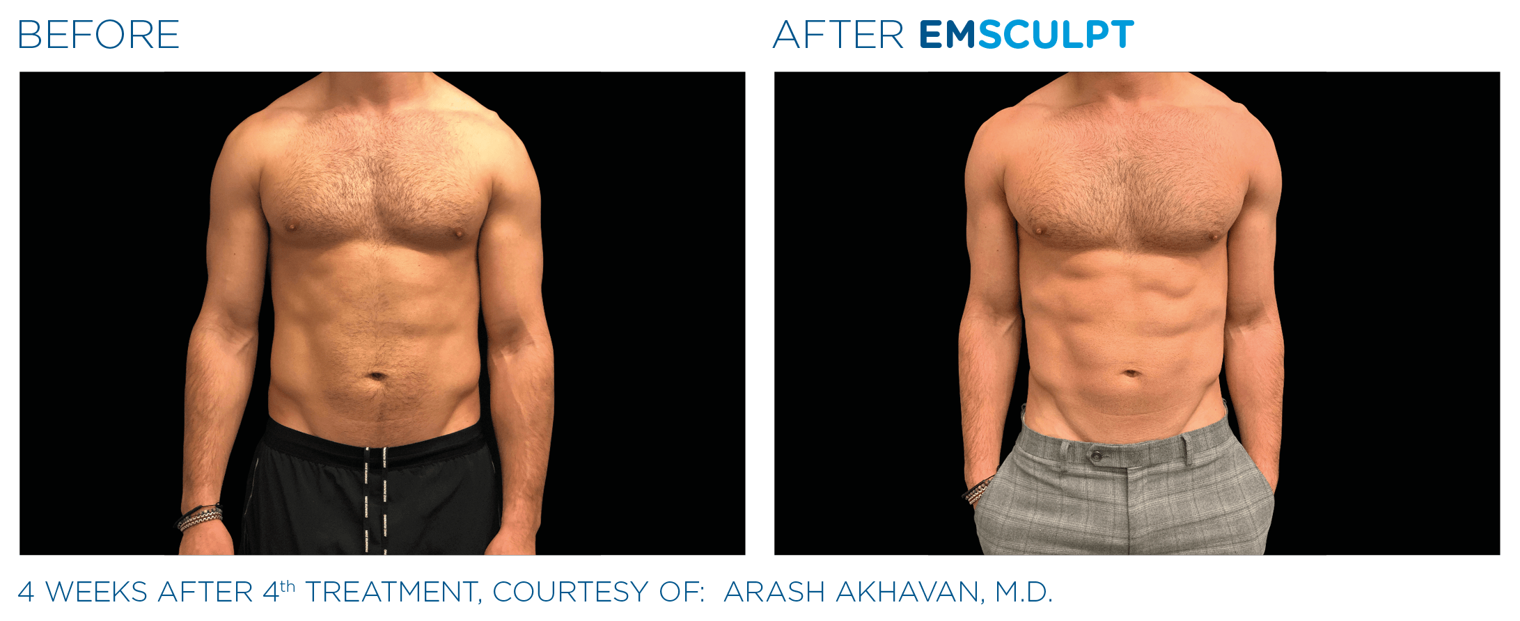 Before and after EMSCULPT