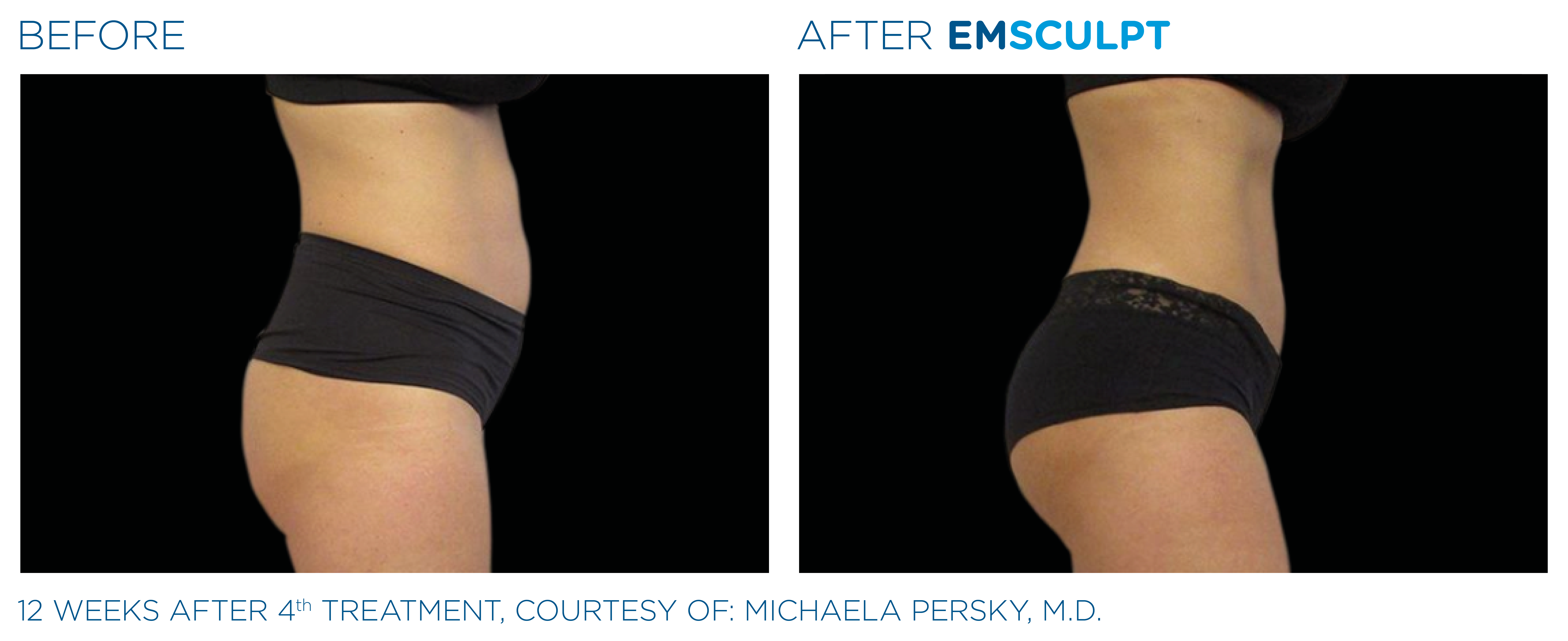 Before and after EMSCULPT
