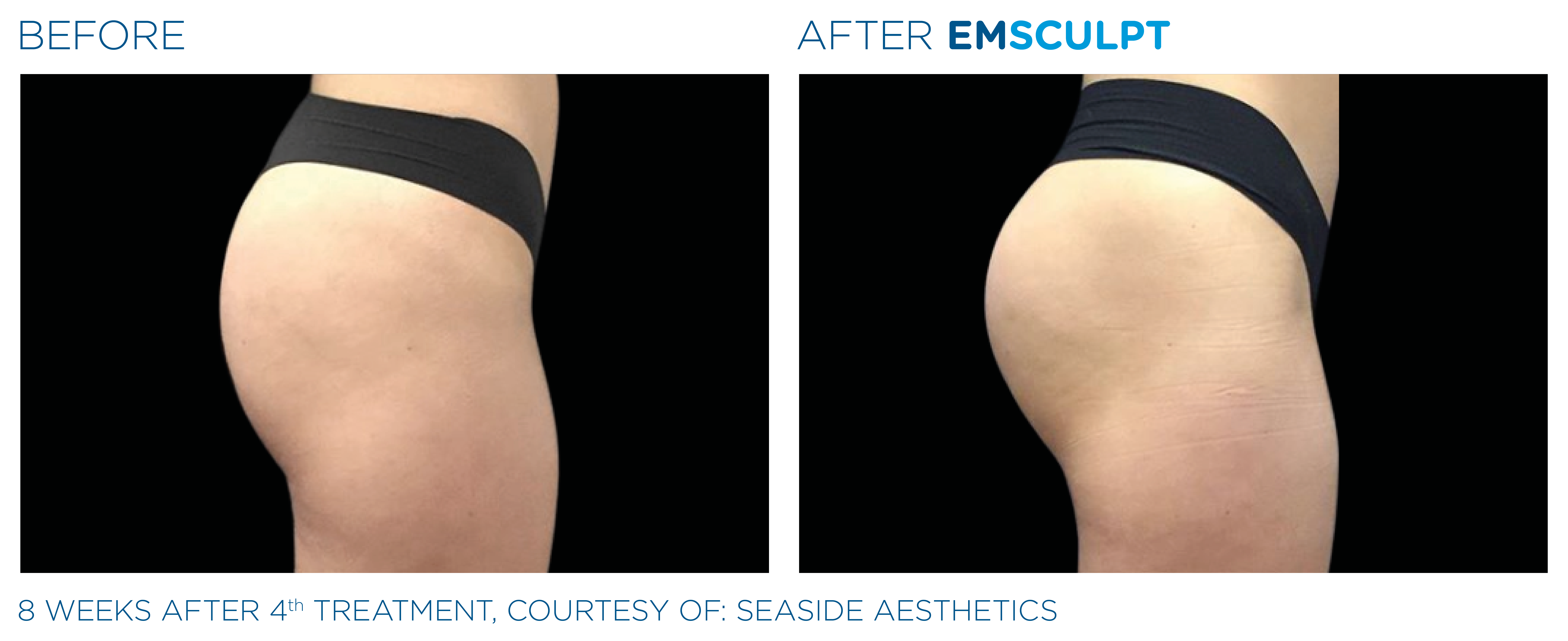 Before and after EMSCULPT