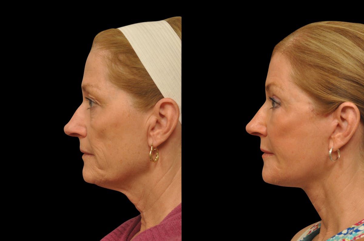 Eyelid Surgery Before & After Gallery - Patient 156269 - Image 3