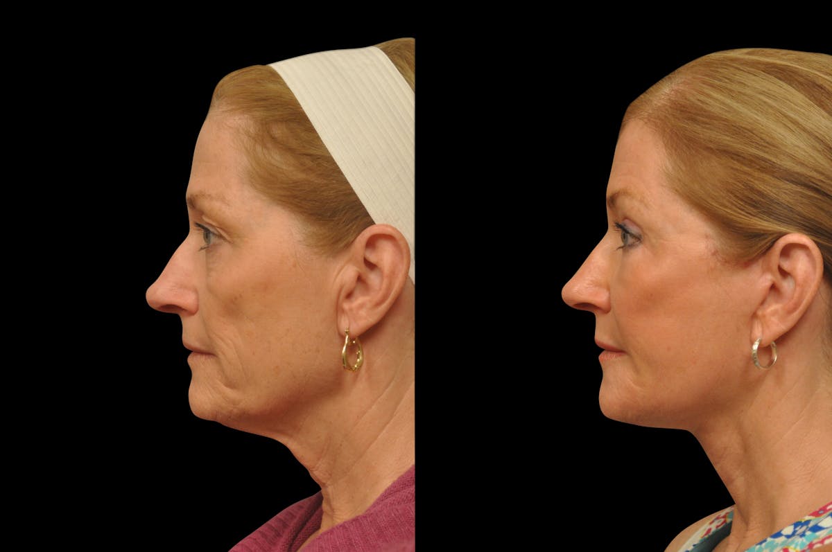 Eyelid Surgery Before & After Gallery - Patient 156269 - Image 2