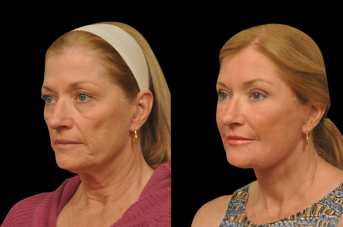 Eyelid Surgery Before & After Gallery - Patient 156269 - Image 1