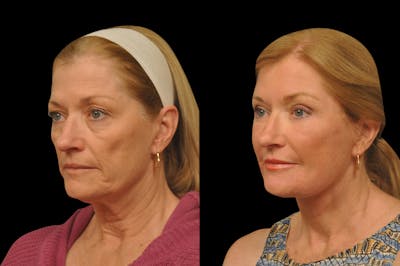 Eyelid Surgery Before & After Gallery - Patient 156269 - Image 1