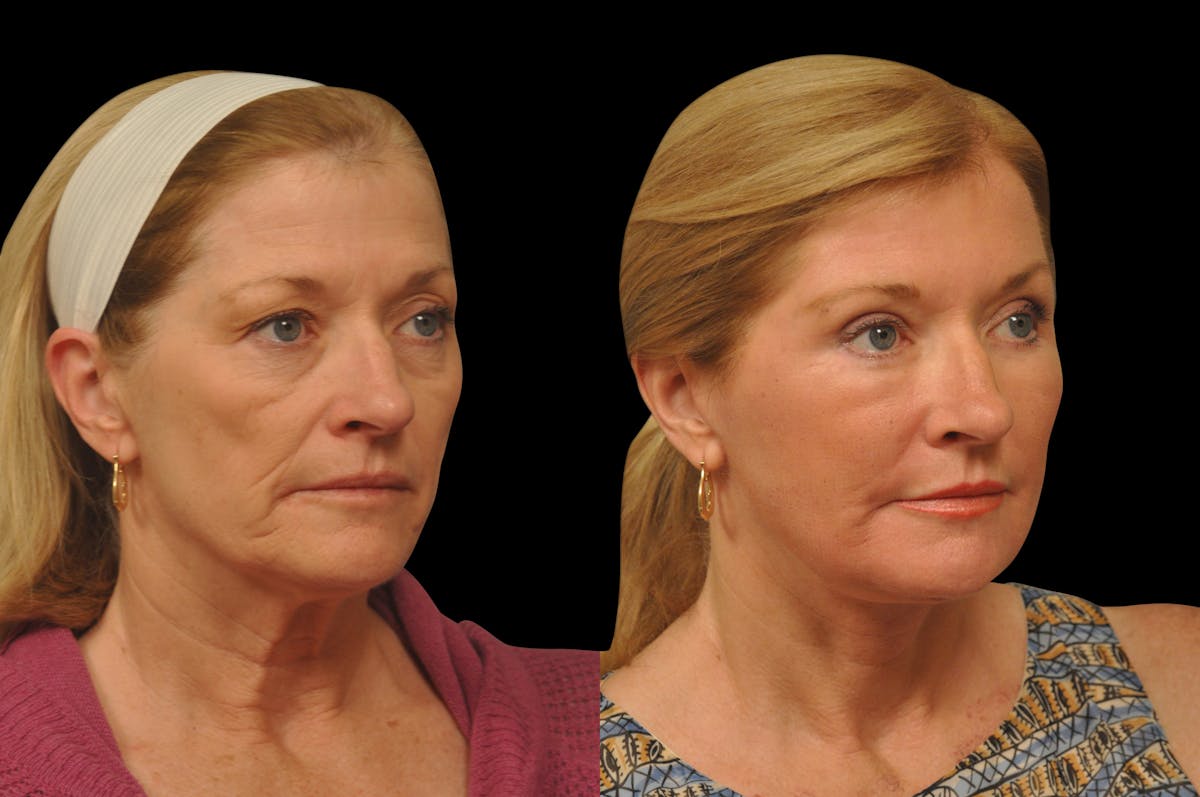 Eyelid Surgery Before & After Gallery - Patient 156269 - Image 4