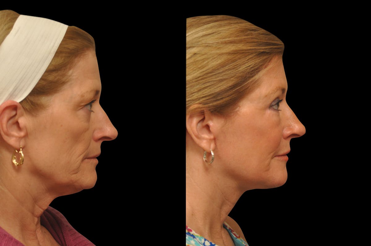 Eyelid Surgery Before & After Gallery - Patient 156269 - Image 4