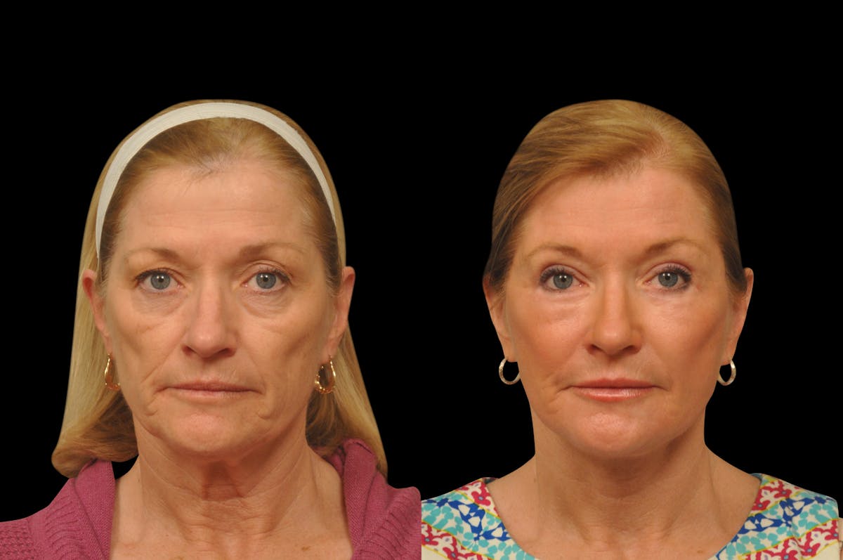 Eyelid Surgery Before & After Gallery - Patient 156269 - Image 1