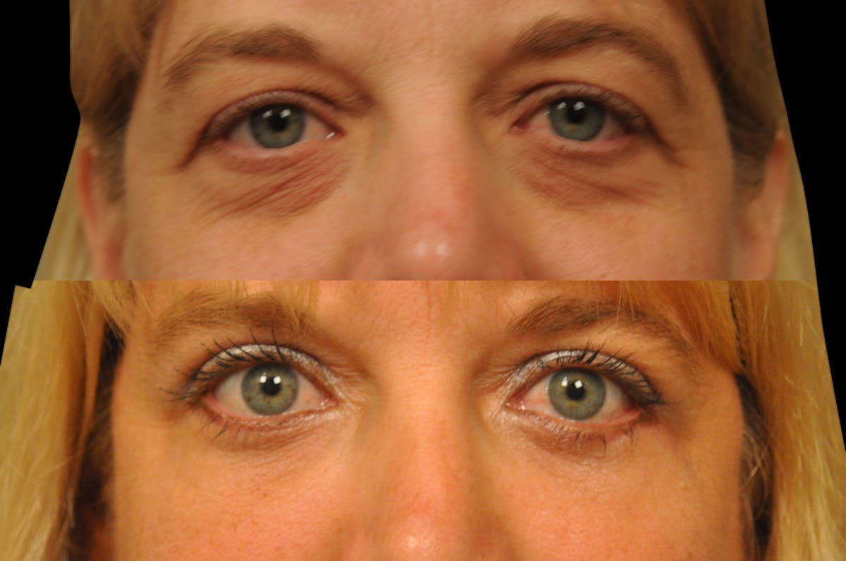 Eyelid Surgery Before & After Gallery - Patient 278208 - Image 2
