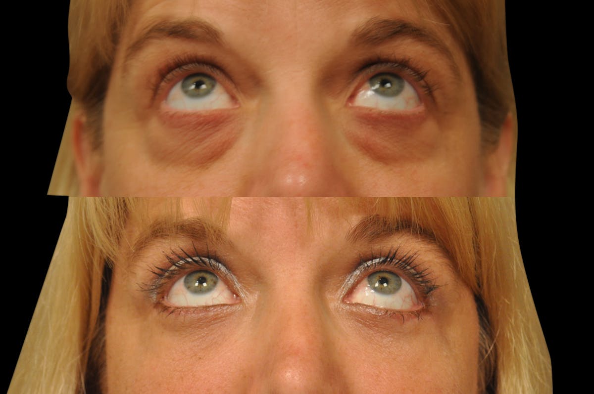 Eyelid Surgery Before & After Gallery - Patient 278208 - Image 4