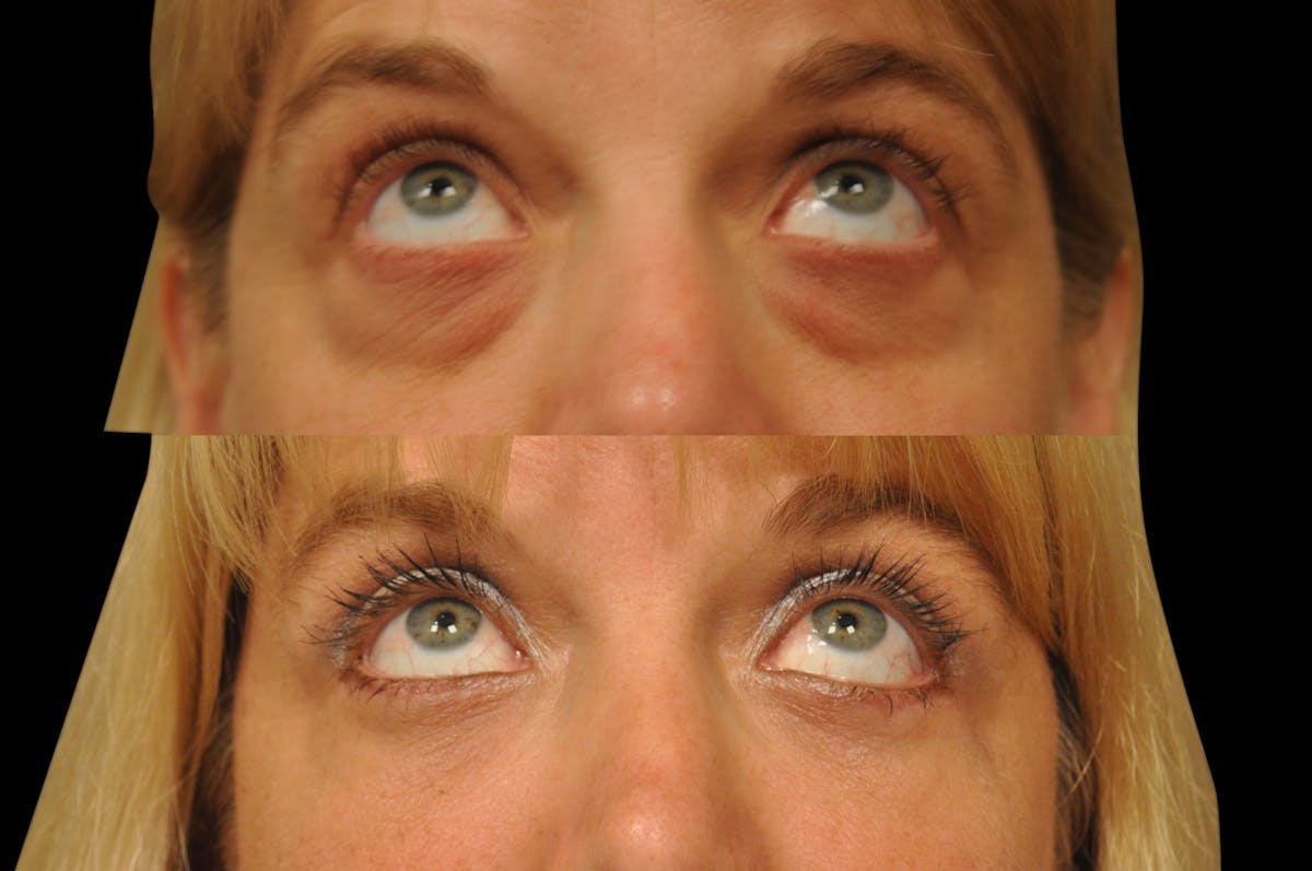 Eyelid Surgery Before & After Gallery - Patient 278208 - Image 3