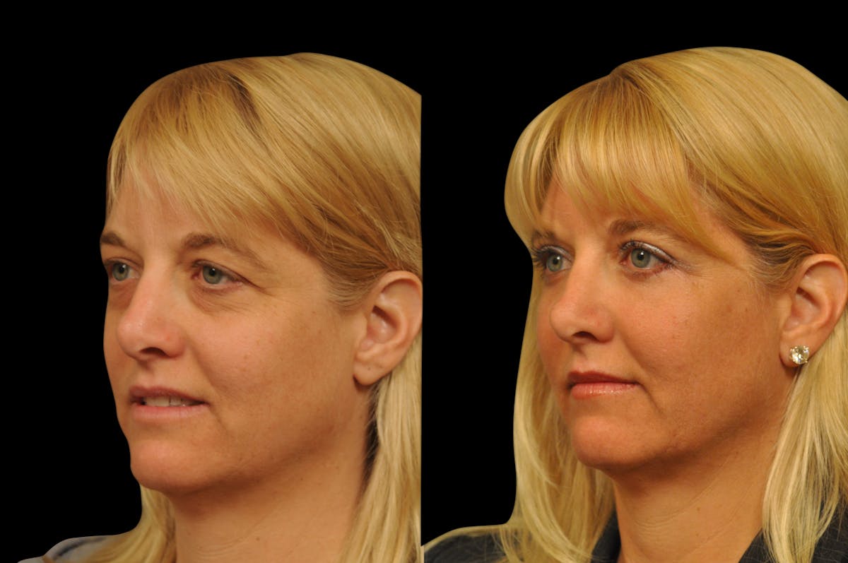 Eyelid Surgery Before & After Gallery - Patient 278208 - Image 2