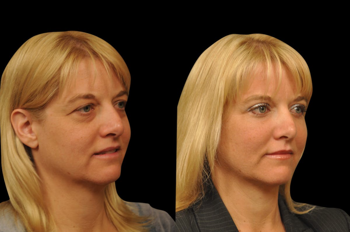 Eyelid Surgery Before & After Gallery - Patient 278208 - Image 6