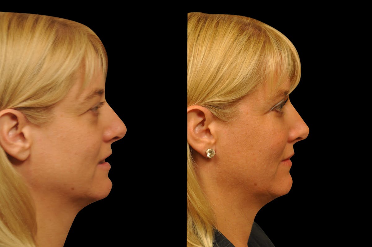 Eyelid Surgery Before & After Gallery - Patient 278208 - Image 7