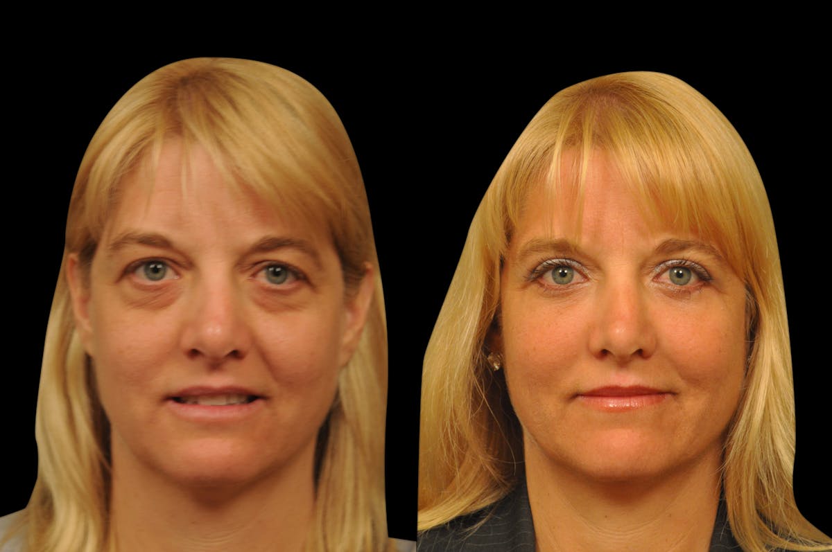 Eyelid Surgery Before & After Gallery - Patient 278208 - Image 1