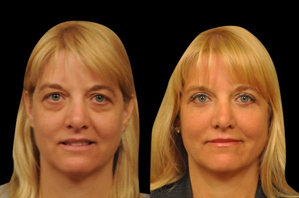 Eyelid Surgery Before & After Gallery - Patient 278208 - Image 1