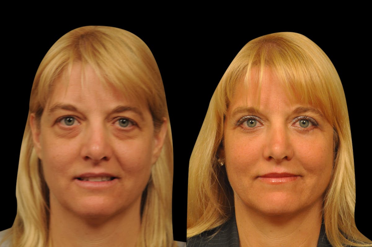 Eyelid Surgery Before & After Gallery - Patient 278208 - Image 7