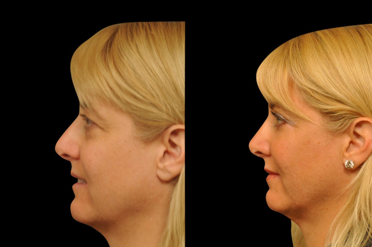 Eyelid Surgery Before & After Gallery - Patient 278208 - Image 5