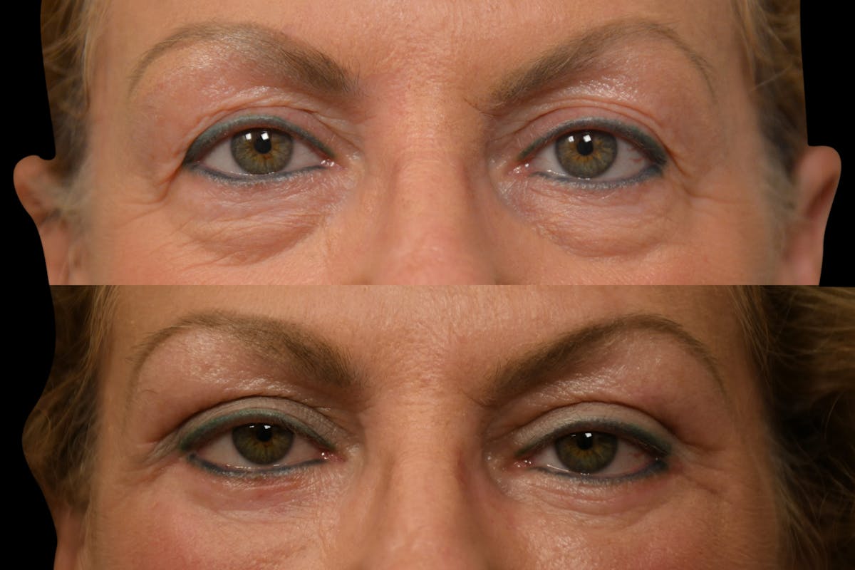 Eyelid Surgery Before & After Gallery - Patient 358426 - Image 3