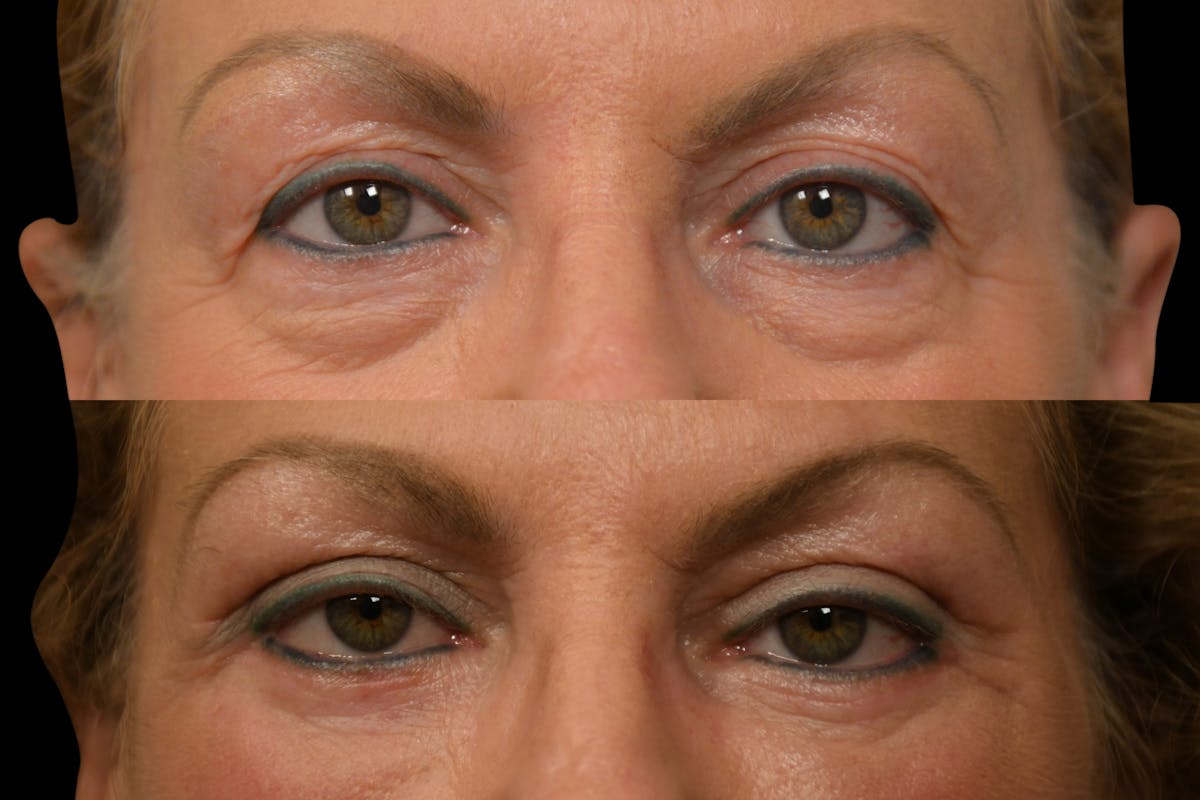 Eyelid Surgery Before & After Gallery - Patient 358426 - Image 2