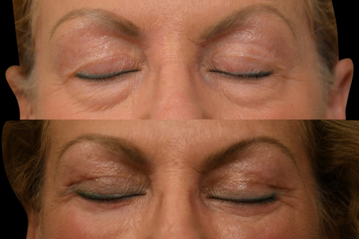 Eyelid Surgery Before & After Gallery - Patient 358426 - Image 4