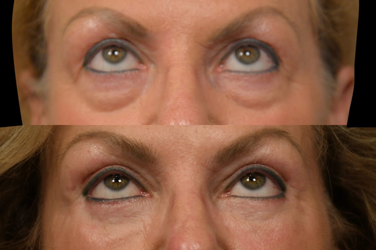 Eyelid Surgery Before & After Gallery - Patient 358426 - Image 4