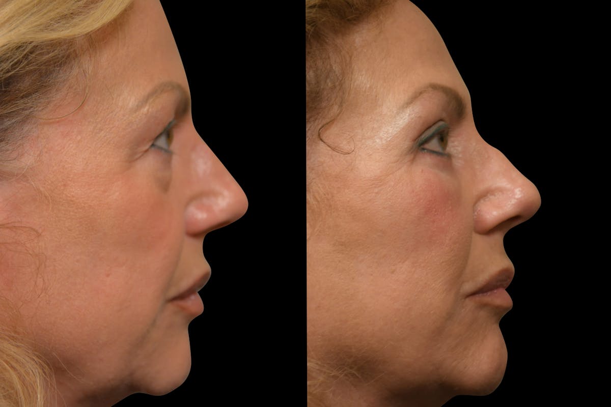 Eyelid Surgery Before & After Gallery - Patient 358426 - Image 9