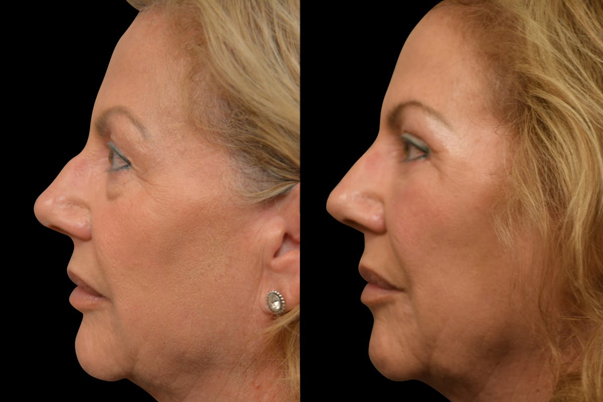 Eyelid Surgery Before & After Gallery - Patient 358426 - Image 7