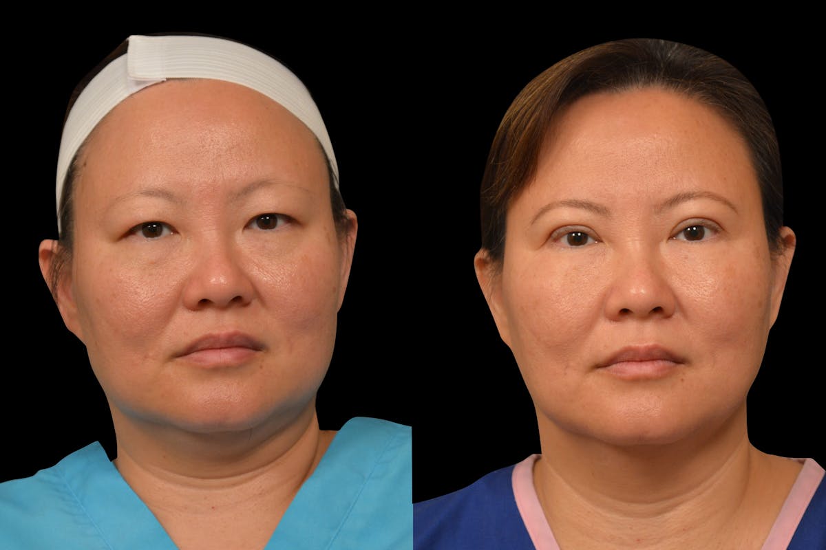 Eyelid Surgery Before & After Gallery - Patient 375482 - Image 5