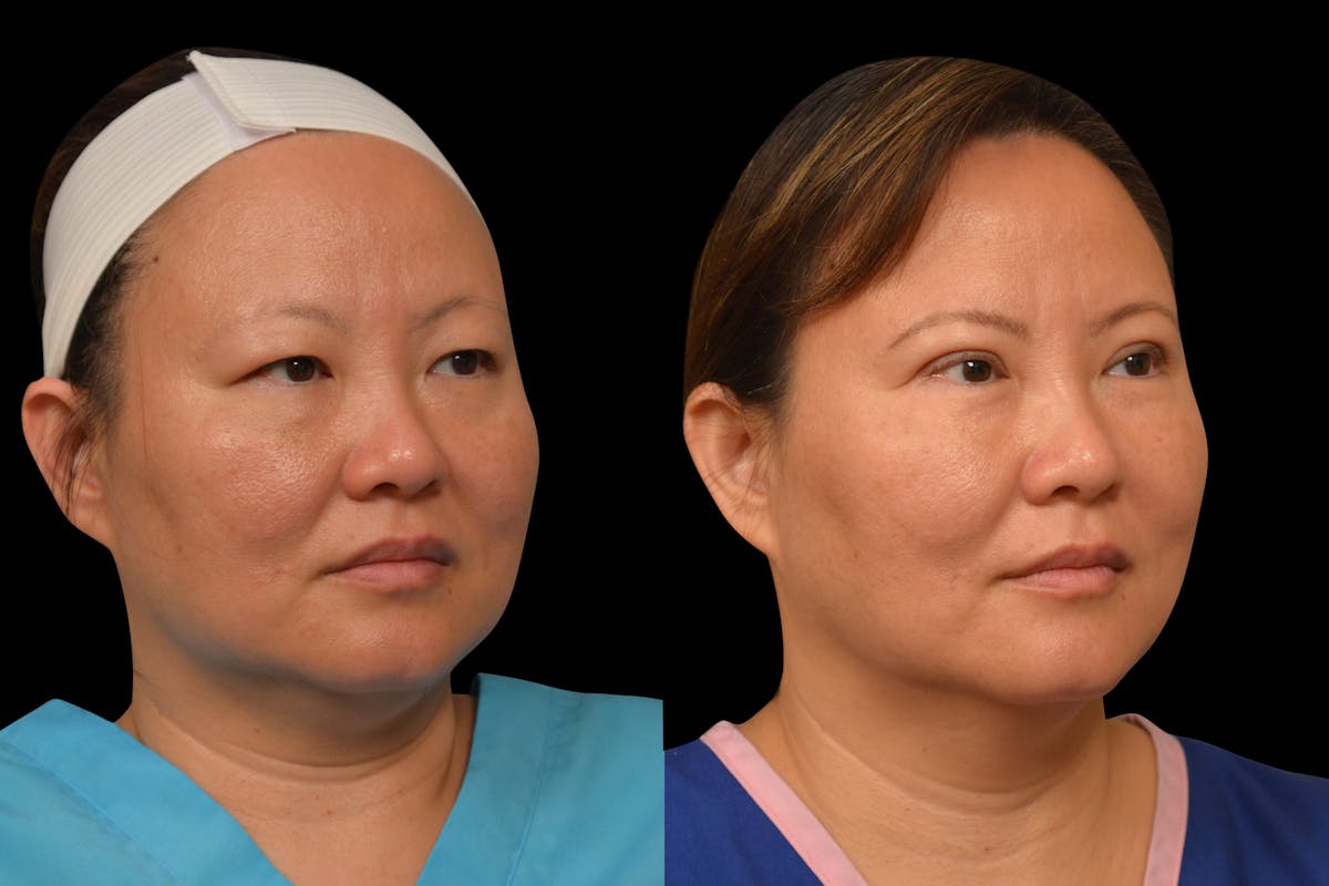 Eyelid Surgery Before & After Gallery - Patient 375482 - Image 4
