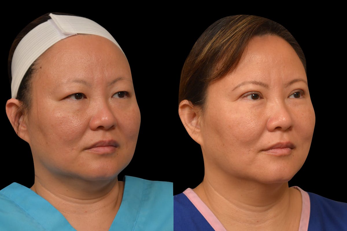Eyelid Surgery Before & After Gallery - Patient 375482 - Image 3