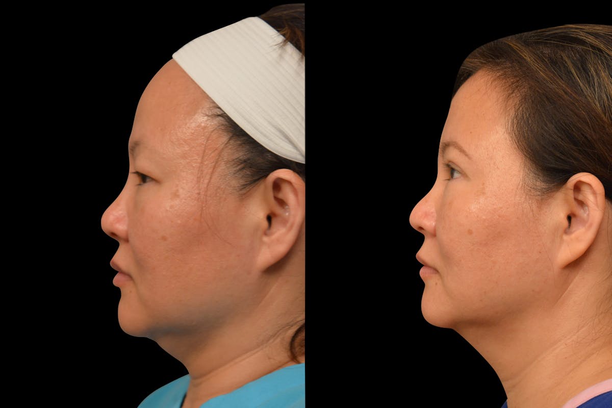 Eyelid Surgery Before & After Gallery - Patient 375482 - Image 3
