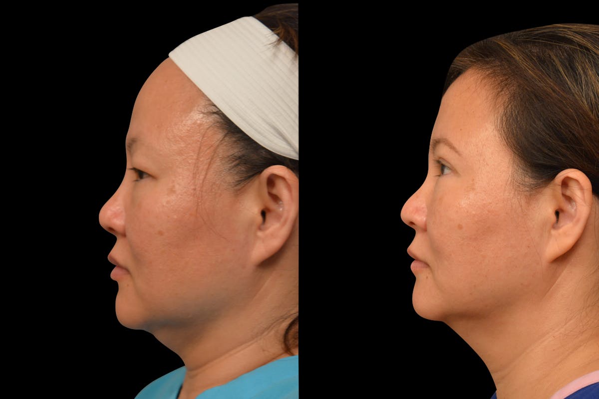 Eyelid Surgery Before & After Gallery - Patient 375482 - Image 2